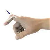 Boutonniere Deformity