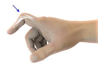 Boutonniere Deformity