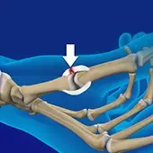 Gamekeeper’s Thumb