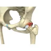 Femoroacetabular Impingement