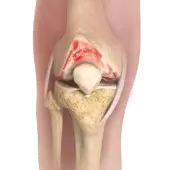 Knee Osteoarthritis