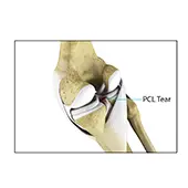 PCL Injuries