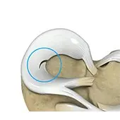 Meniscal Tears