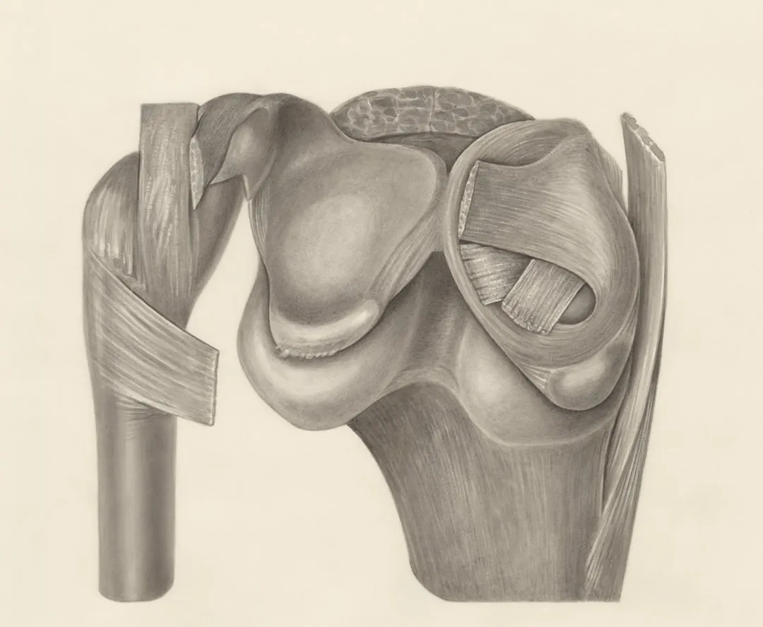 Why an ACL Tear Often Comes With a Side of Fracture
