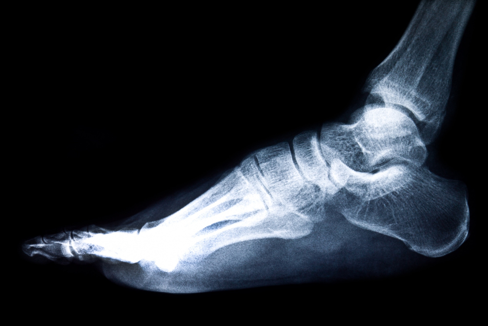 Foot Stress Fractures: Signs, Causes, and Treatment