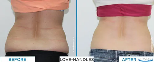 Before and after fat freezing treatment on love handles