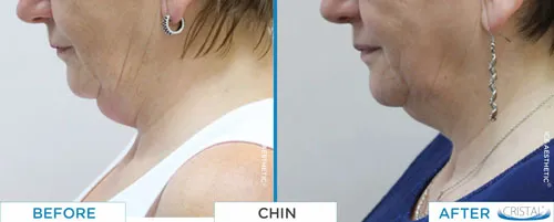 fat freezing before and after photos for the chin