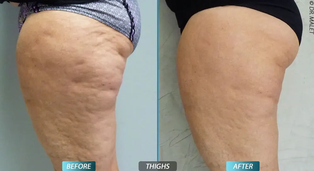 fat freezing before and after photos for thighs
