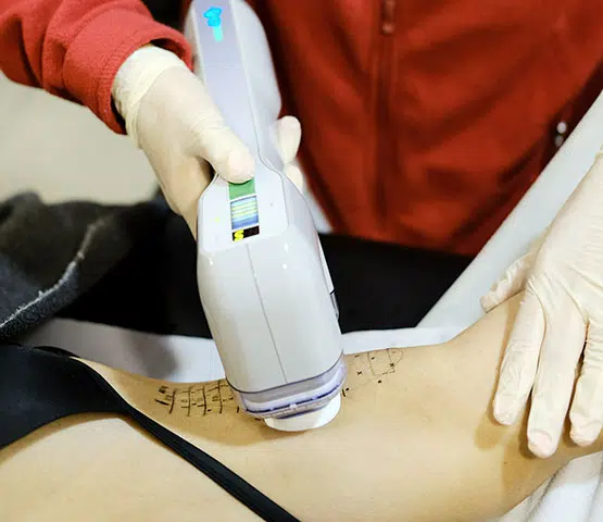 miraDry sweat treatment being applied to a woman's armpit
