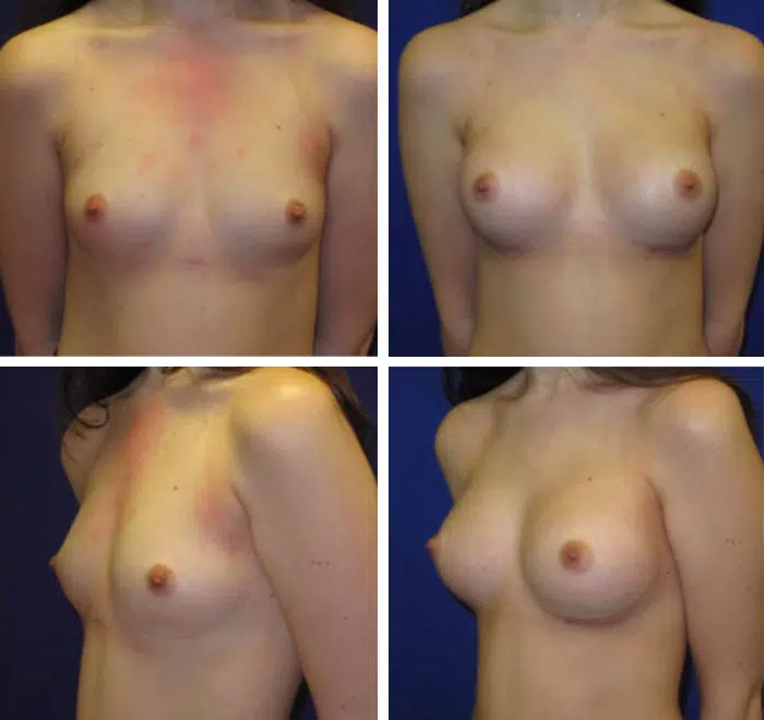 25-34 year old woman treated with Breast Augmentation