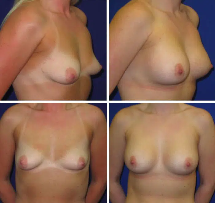 25-34 year old woman treated with Breast Augmentation