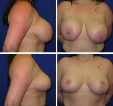 Breast Lift Before and After 35-44 year old woman