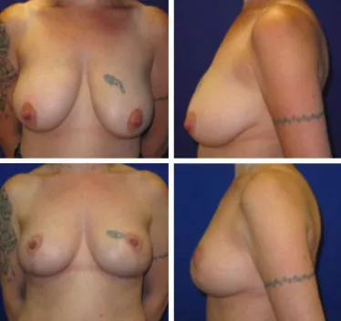 Breast Lift Before and After 25-34 year old woman