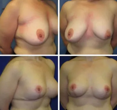 Breast Lift with Implants Before and After 25-34 year old woman
