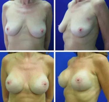 Breast Lift with Implants Before and After 25-34 year old woman
