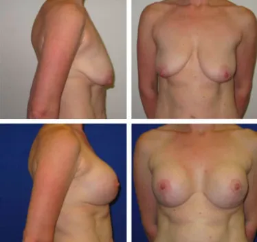 Breast Lift with Implants Before and After 25-34 year old woman
