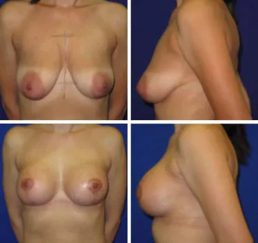 Breast Lift with Implants Before and After 25-34 year old woman