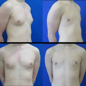 before and after male breast reduction