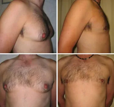 male breast reduction surgery before and after