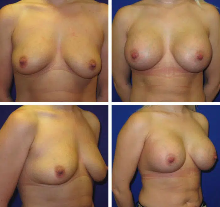 25-34 year old woman treated with Breast Augmentation