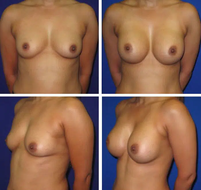 breast augmentation before and after