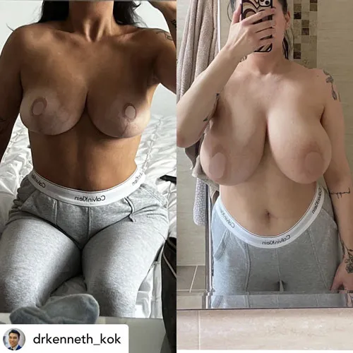 Breast reduction scar