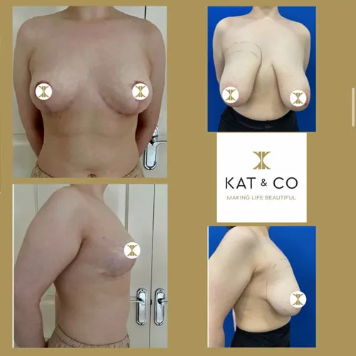 breast reduction before and after