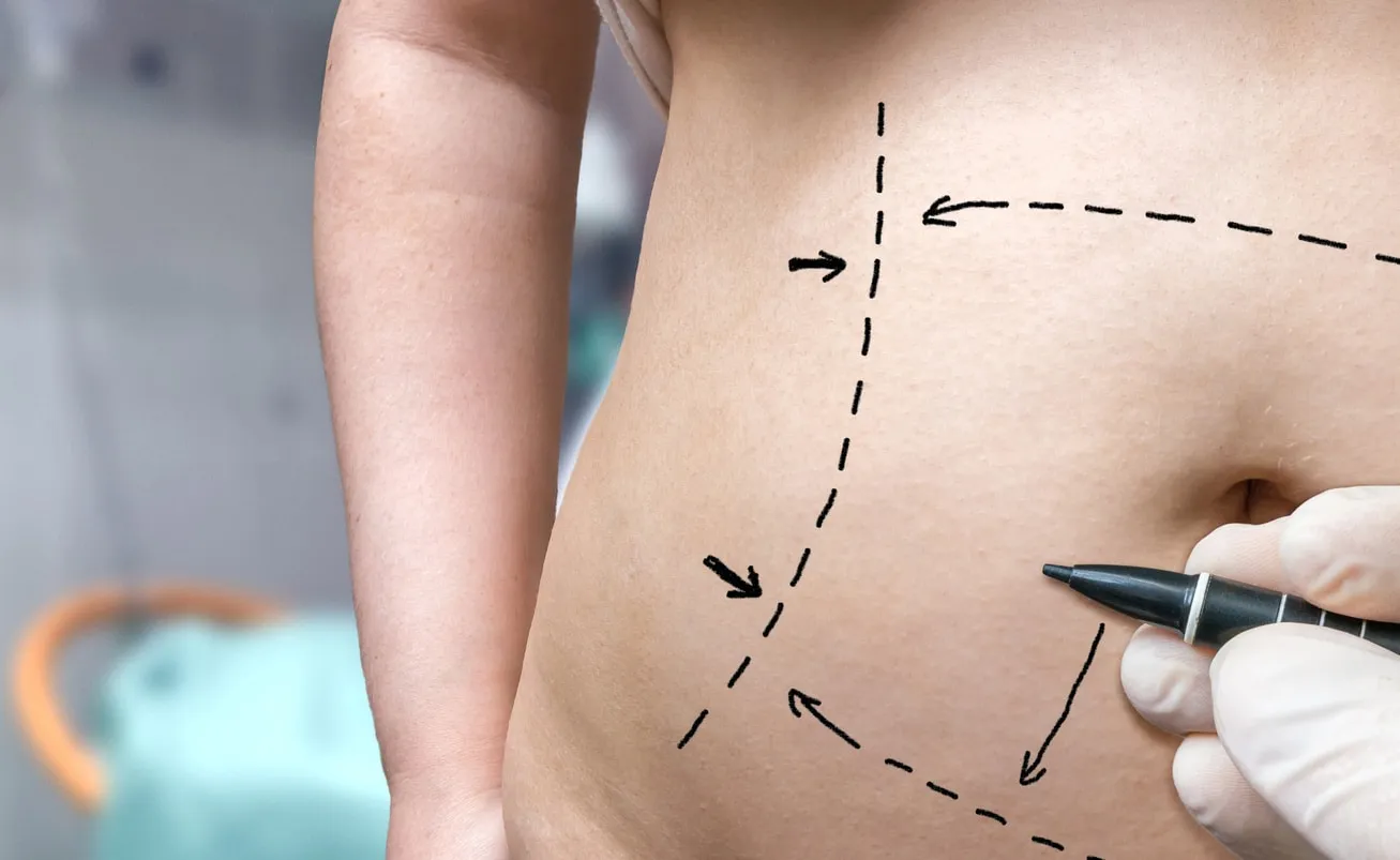 Surgical markings for vaser liposuction