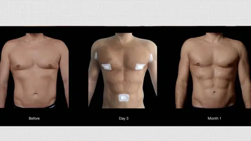 before and after vaser liposuction chest and tummy male