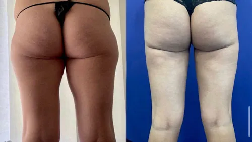 before and after vaser liposuction buttocks and thighs