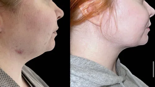 before and after vaser liposuction to the chin