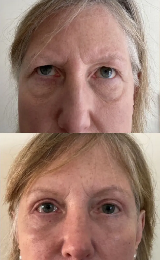 upper and lower blepharoplasty before and after in an older woman