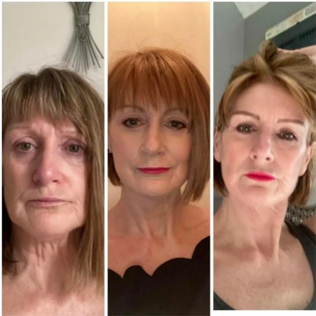 upper and lower blepharoplasy before and after