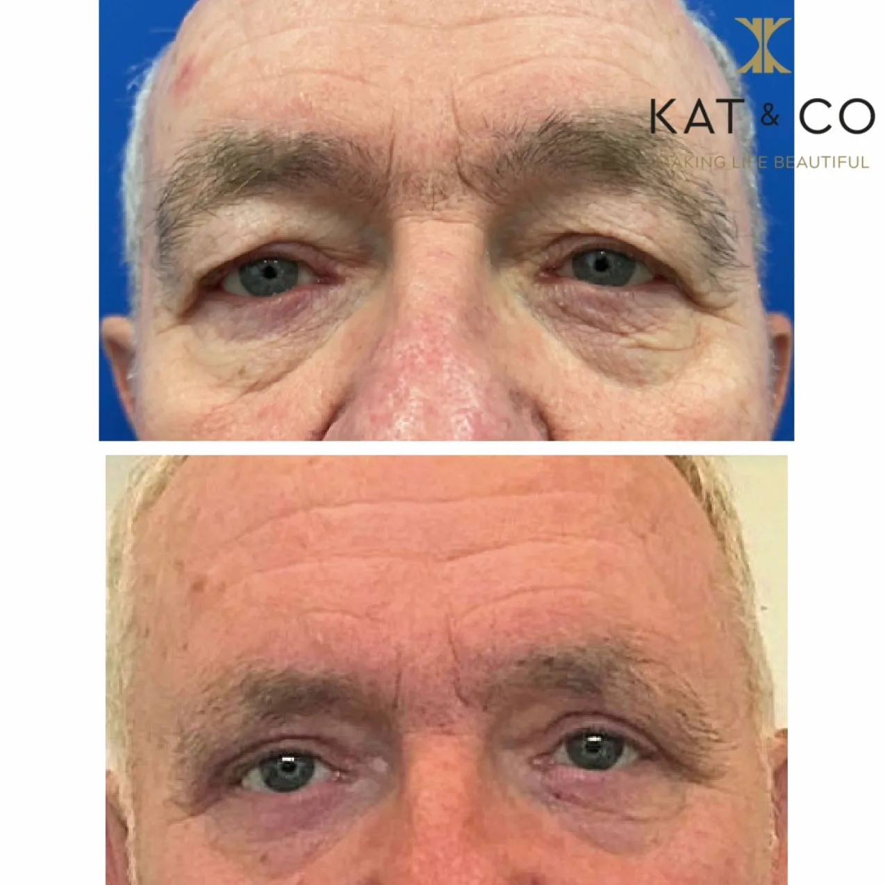 Upper eyelid surgery before and after
