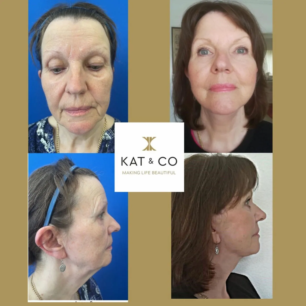 eyelid surgery before and after