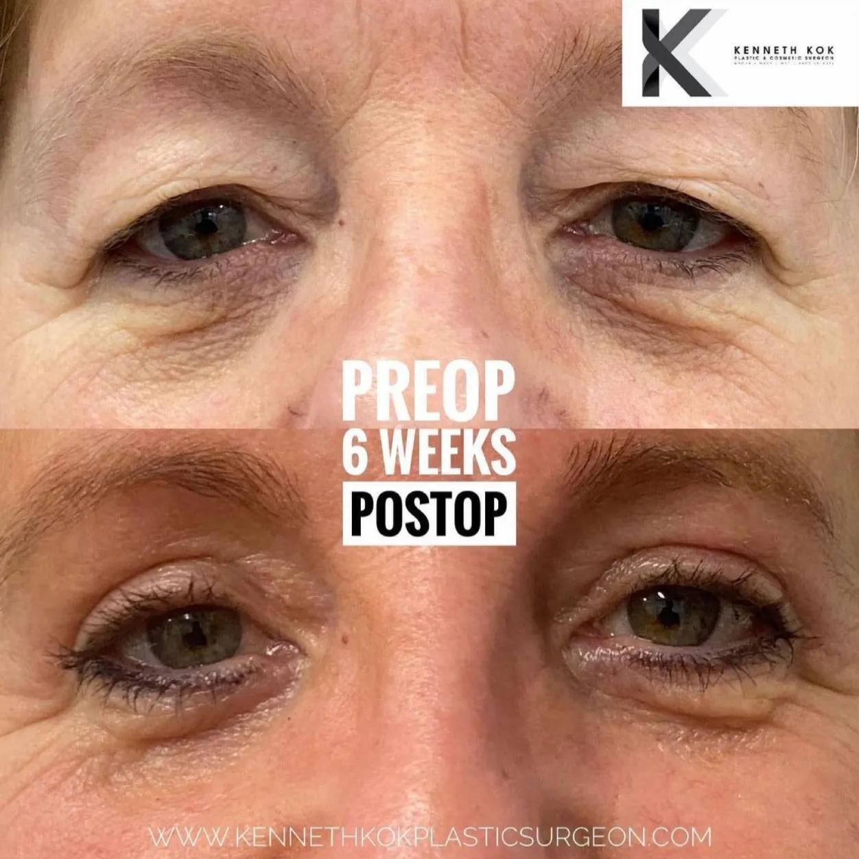 Upper blepharoplasty surgery before and after