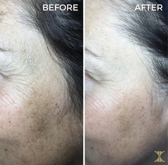 Breast reduction scar