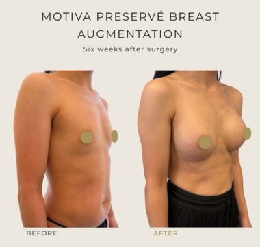 Preserve patient before and after