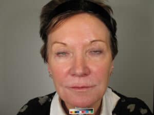 co2 laser resurfacing