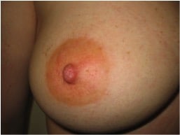 inverted nipple after 2
