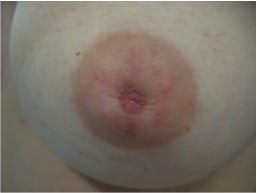 nipple eversion before 2