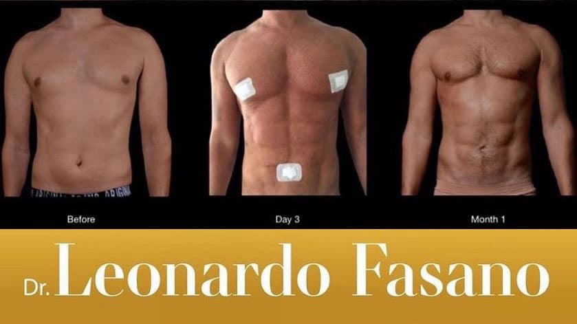 vaser liposuction before and after with dr leo