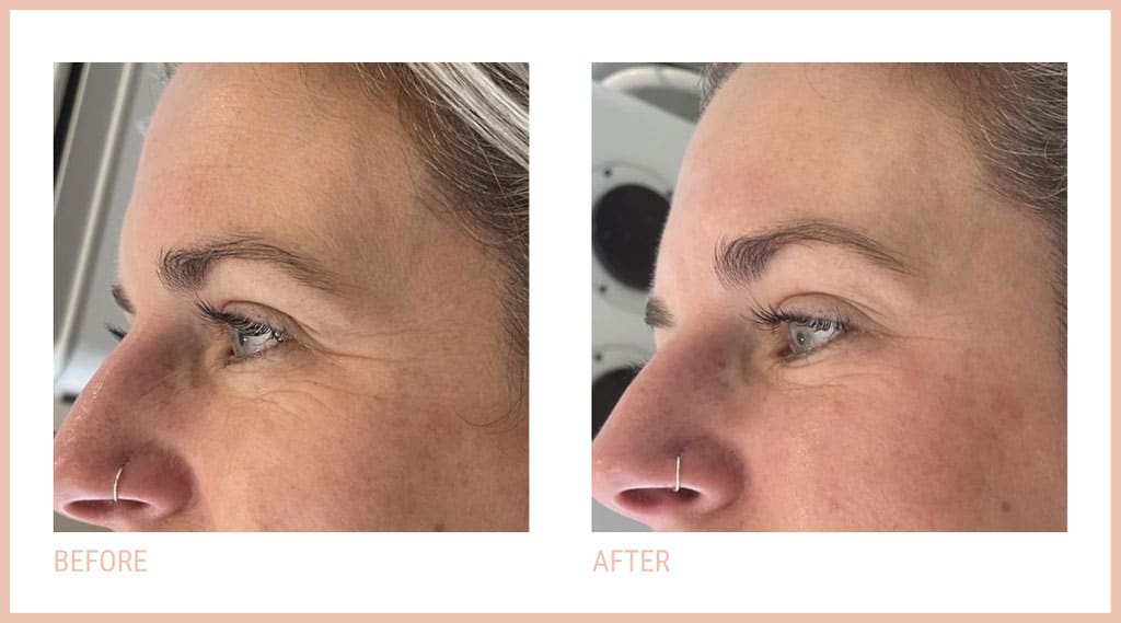 Woman Before and After CACI Synergy Treatment