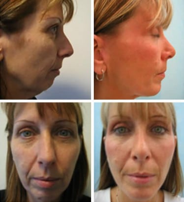 MACS facelift before and after