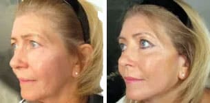one stitch mini-facelift before and after