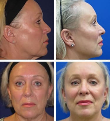 SMAS facelift before and after photos of a woman
