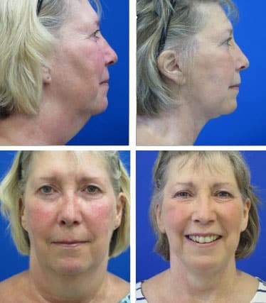 necklift before and after of a woman between 45 and 55 years