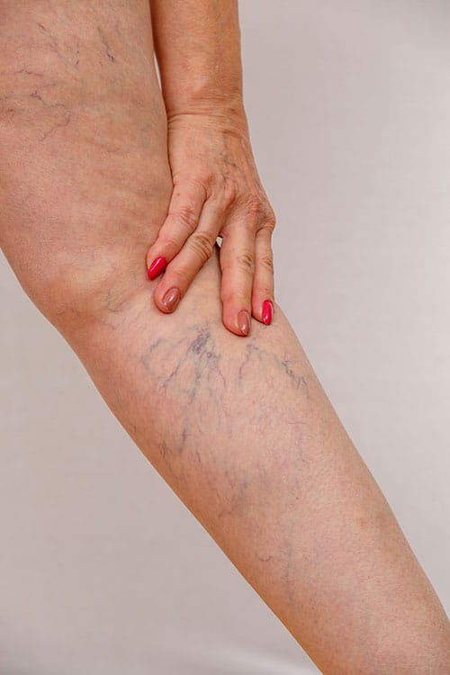Varicose veins on female leg