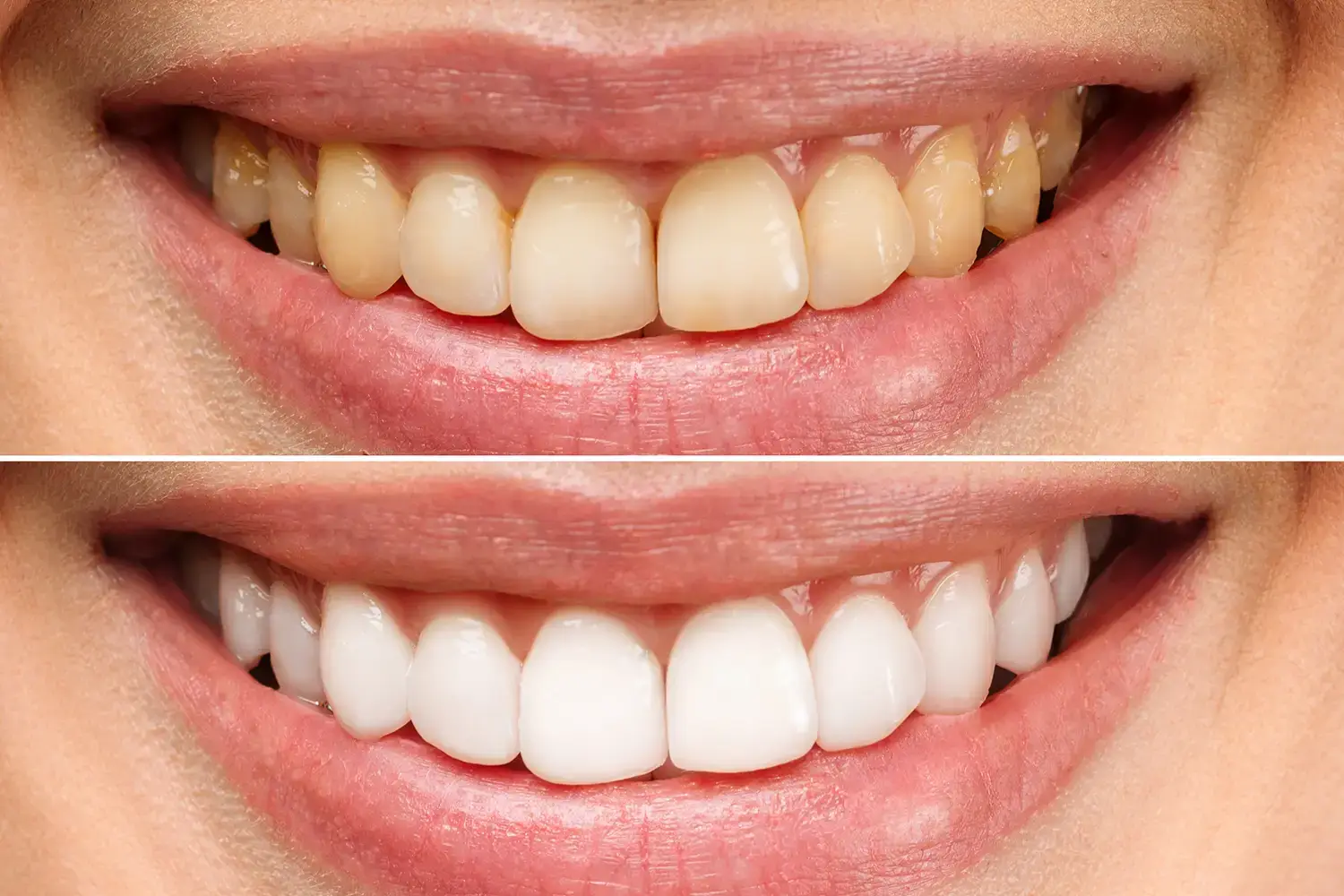 Before and after photo of a tooth whitening treatment