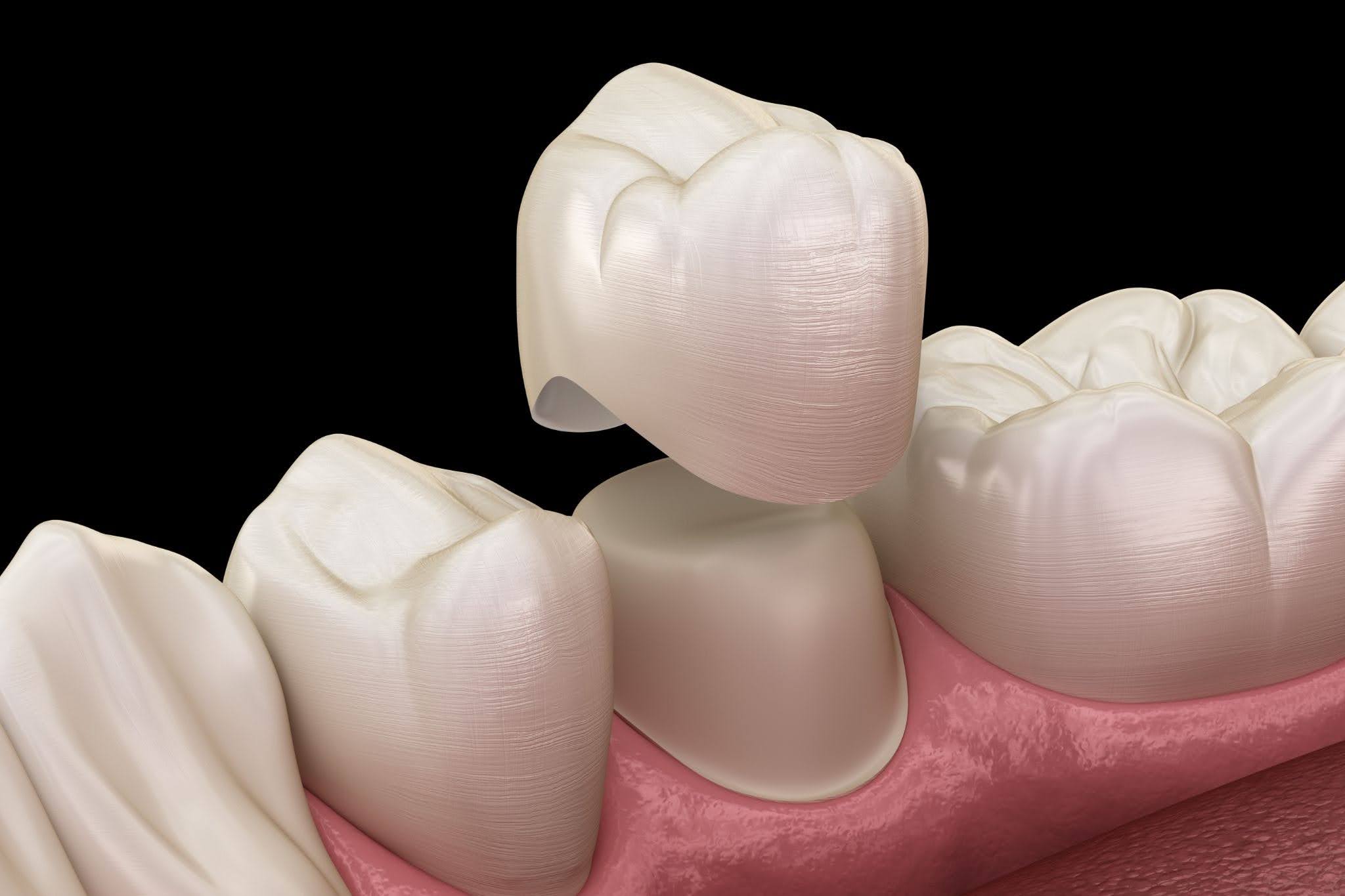 Perfectly fitted dental crown being placed on a tooth in Midlothian, TX, during a same-day appointment with Soothing Dental